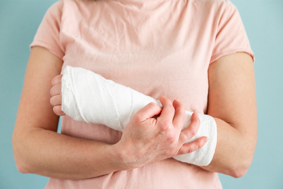 A imagem mostra uma mulher com o braço quebrado, com uma bandagem de gesso. A imagem ilustra o texto "Auxílio Acidente: o que é, quem tem direito e como funciona?" de Koetz Advocacia.